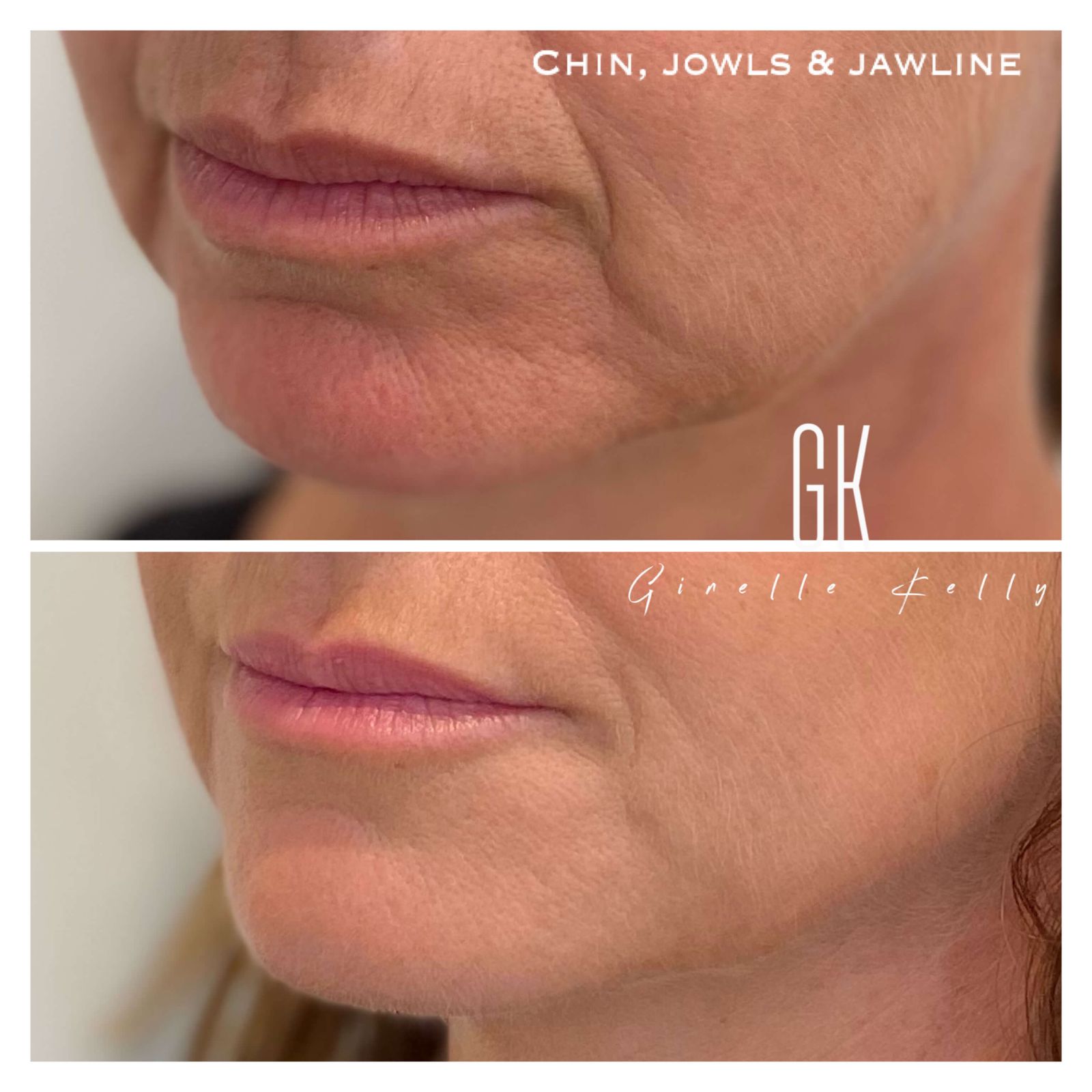 Dermal fillers for jowls before and after by Form&Face