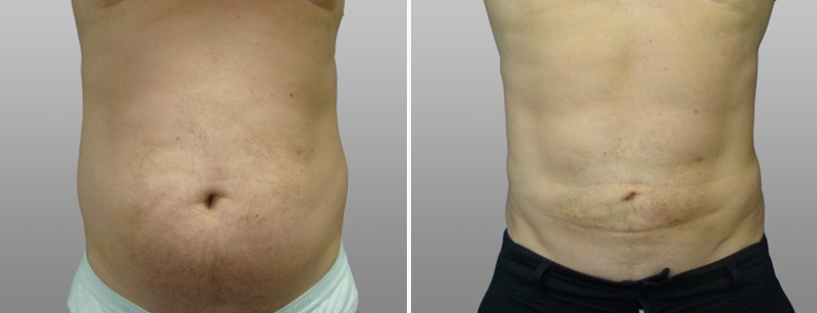 Male Liposuction Before And After Images Form Face