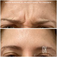 Anti-wrinkle-injections-to-frown-client-53