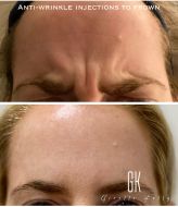 Anti-wrinkle-injections-to-frown-client-58