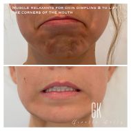 Anti-wrinkle-injections-to-relax-the-corners-mouth-and-a-dimpling-chin-44