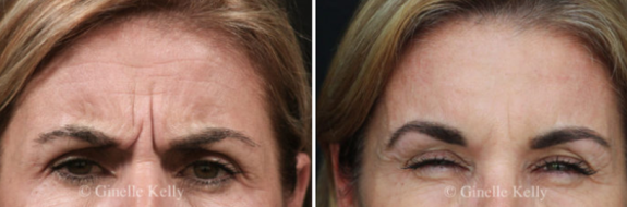 Anti-wrinkle injections before and after, image 01, Form & Face Sydney