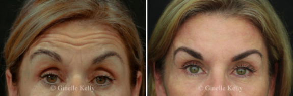 Wrinkle relaxers before and after gallery, image 02