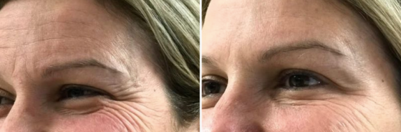 Anti wrinkle injections before & after, image 03
