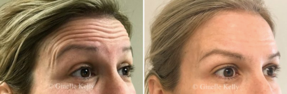 Anti-wrinkle injections, image 04, before & after gallery