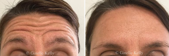 Anti wrinkle injections to forehead wrinkles, before & after image 06