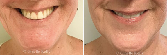 Anti wrinkle injections gallery, Form & Face clinic Sydney, before and after image 08