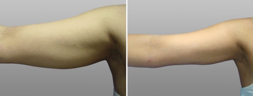 Before and after arm lift,  patient 02