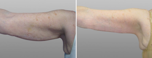 Arm Lift (Brachioplasty), before and after images, patient 03