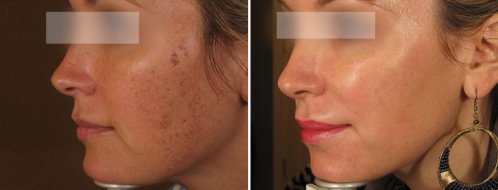 BBL Pigmentation photo gallery, image 01, before and after image