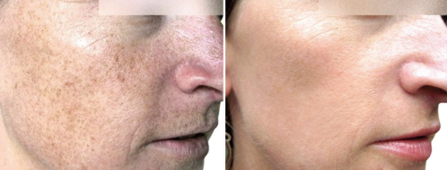 BBL Pigmentation before and after image 03,  Form & Face