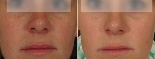 Patient before an after BBL Pigmentation treatment, image 05