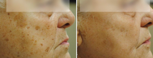 BBL Pigmentation before and after, image 06