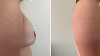 Breast Abnormality client2
