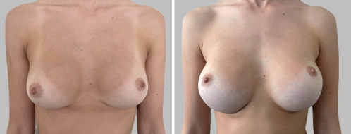 Revision breast augmentation for bottoming-out (original done by another surgeon) : After photos 4 months postoperative, front view