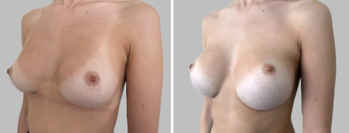 Revision breast augmentation for bottoming-out (original done by another surgeon) : After photos 4 months postoperative, angle view