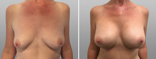Patient 56,  Breast Augmentation Mammoplasty  (Implants) before surgery, image 102, front view