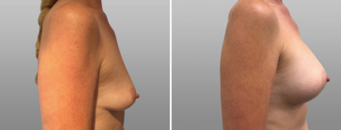 Breast enlargement surgery, patient 56, before & after photo 104, side view