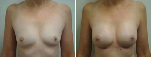 Breast augmentation patient, before and after gallery, image 11, front view