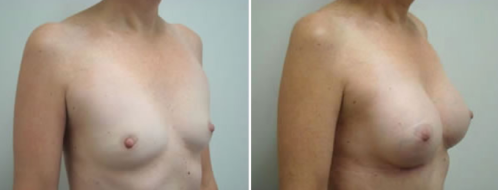 Breast augmentation patient 05, before & after image 12, angle view