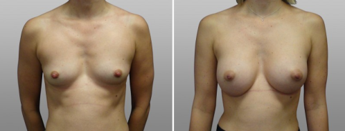 Patient 05, image 13, Breast Augmentation Mammoplasty (Implants) before and after images, front view