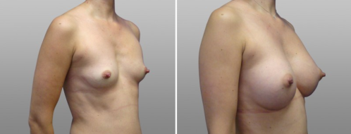Dr Norris Breast Augmentation Mammoplasty (Implants), patient 8, image 14, angle view