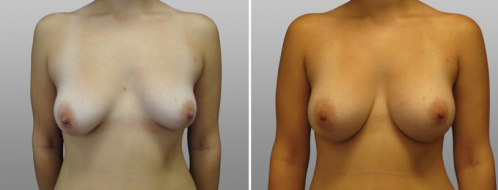Breast Augmentation Mammoplasty (Implants) surgery in Sydney, patient 10, Dr Norris, front view