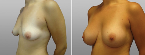 Breast augmentation with implants, before and after image, patient 10, image 19, angle view