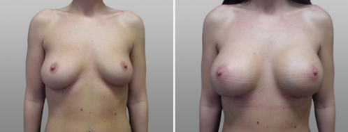 Breast enlargement images, patient 11, before & after images, front view