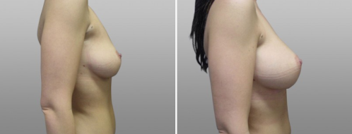 Breast augmentation before and after, patient 11, image 23, side view