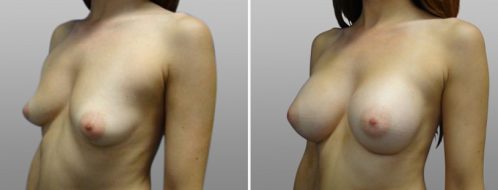 Breast augmentation in Sydney, Dr Norris, patient 12, before and after