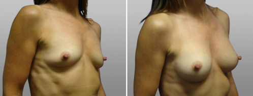 Breast Augmentation Mammoplasty (Implants)  surgery images, patient 15, angle view