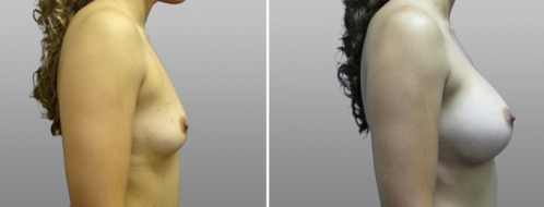 Breast implants before and after gallery, image 03, side view