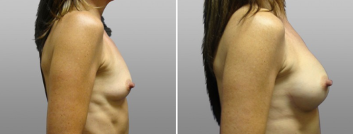 Breast augmentation before and after, patient 15, Dr Norris, Sydney