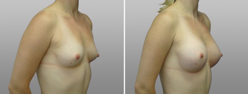 Breast enlargement surgery, before & after images, patient 16, angle view