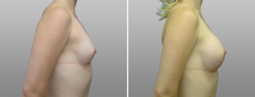 Photo gallery, Breast Augmentation Mammoplasty (Implants) surgery, patient 16, side view