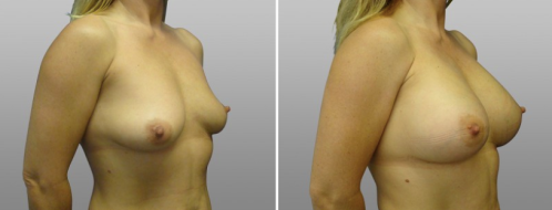 Breast augmentation surgery patient 19, Form & Face, image 36, angle view