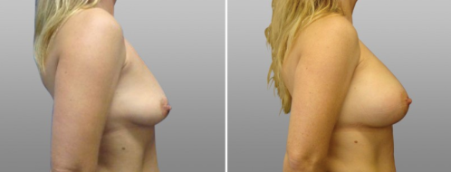 Breast Augmentation Mammoplasty (Implants)  before and after images, patient 19, image 37, side view