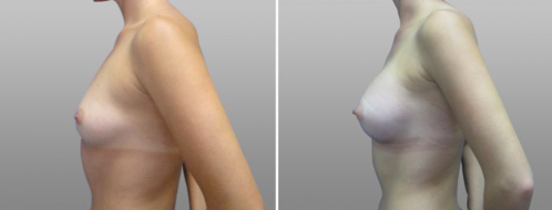 Breast Augmentation Mammoplasty (Implants) before and after images, Form & Face clinic Sydney, patient 20, side view