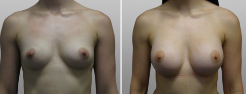 Patient, before and after breast augmentation, image 04, front view
