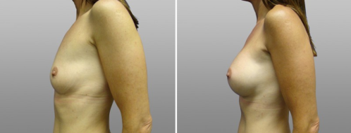 Breast implants surgery at Form & Face clinic in Sydney, patient image 41