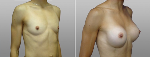 Form & Face patient 26 before and after breast augmentation procedure, image 47