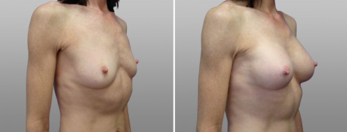 Breast augmentation gallery, patient 28, image 49, Form & Face