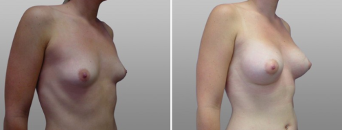 Best breast augmentation in Sydney, patient 29, image 51, angle view