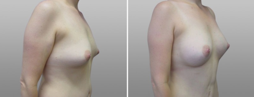 Breast Augmentation Mammoplasty (Implants) in Sydney, patient 30, image 52, angle view