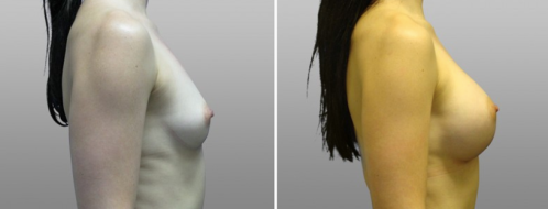 Image 06, Patient Before and after images of  Breast Augmentation Mammoplasty (Implants) surgery photos, side view