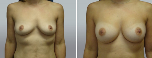 Breast Augmentation Mammoplasty (Implants) , before and after images, patient 34, image 60