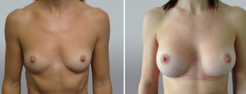 Patient 35 before and after breast implants surgery, Form & Face Sydney, Dr Norris