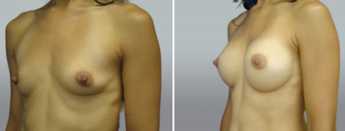Patient 38 before and after breast augmentation, image 67, angle view