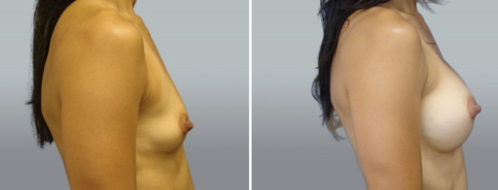 Breast augmentation patient 38, before and after surgery, side view